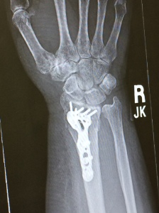 36 Hours after that sunset, this what the inside of wrist looked like. And still does. 5 pegs, a plate and 3 screws. The plate is a very pretty shade of green.